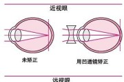 远视眼镜是一种什么镜，远视眼镜一般多少钱