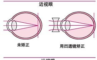 远视眼镜是一种什么镜，远视眼镜一般多少钱