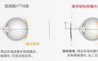 豪雅环周离焦镜片怎么样，豪雅环周离焦镜片怎么样好用吗